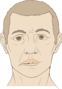 bell's palsy, facial paralysis