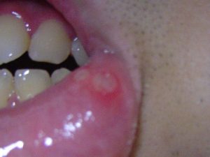 mouth ulcer, canker sore
