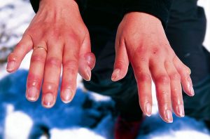 Chilblains, hands, swollen joints, frostbite