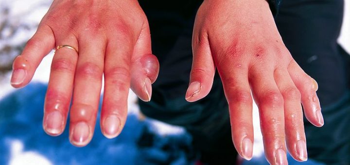Chilblains, hands, swollen joints, frostbite
