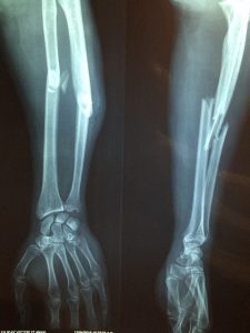 bone, x-ray, fracture