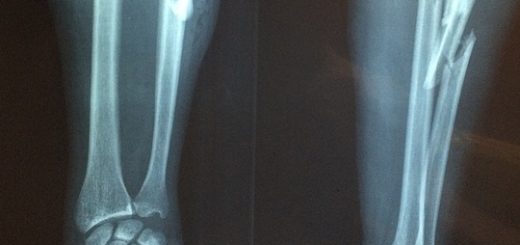 bone, x-ray, fracture