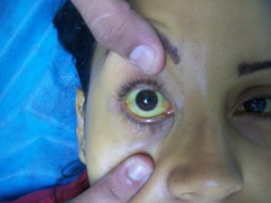 eyes, jaundice, yellow fever, vaccinated