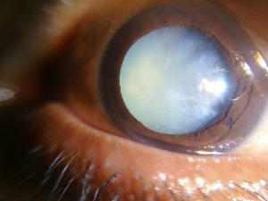 cataract, eye