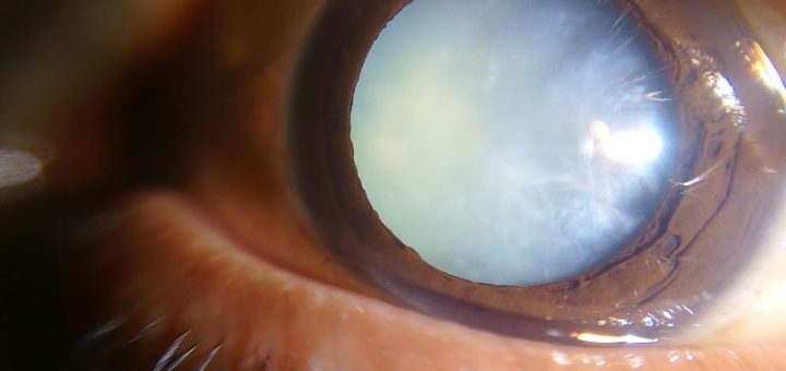cataract, eye