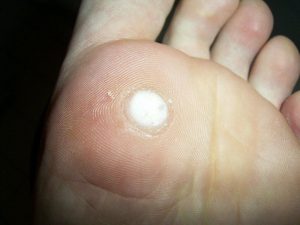 plantar wart, wart, home remedies for warts