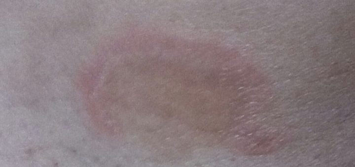 ringworm, fungal infection, home remedies for ringworm