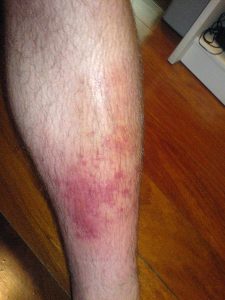 cellulitis, home remedies for cellulitis,