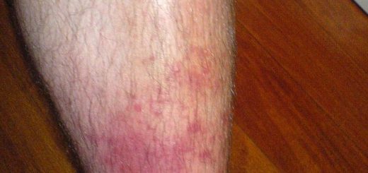 cellulitis, home remedies for cellulitis,