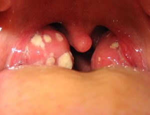 home remedies for tonsillitis, tonsils
