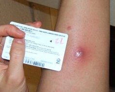 home remedies for staph infection, staph infection