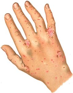 scabies, bug bites, home remedies for scabies