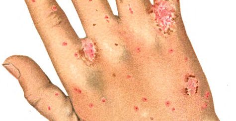 scabies, bug bites, home remedies for scabies