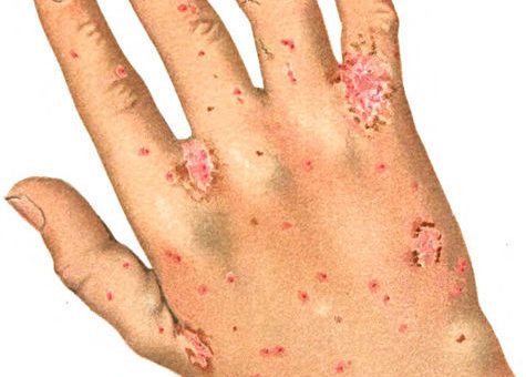 scabies, bug bites, home remedies for scabies