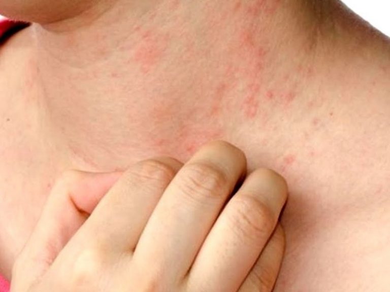 6 Exclusive Home Remedies For Lupus Home Remedies For All Kinds Of