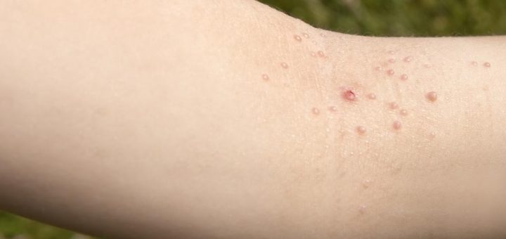 molluscum contagiosum