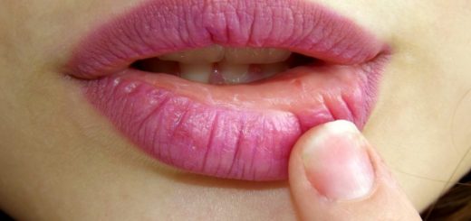 Cracked Lips