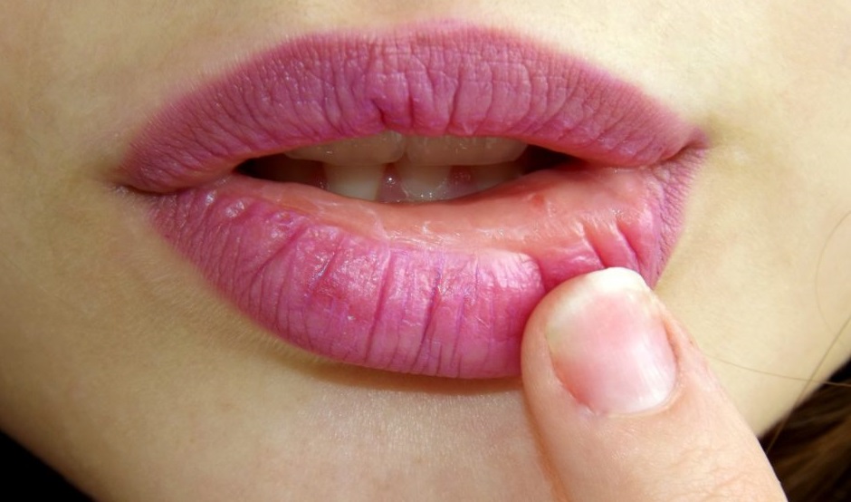 Cracked Lips