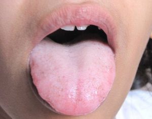 coated tongue