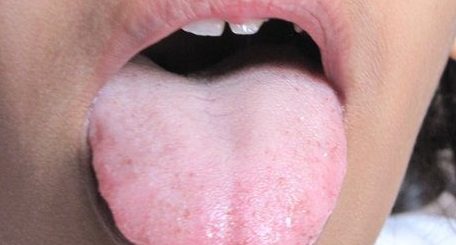 coated tongue